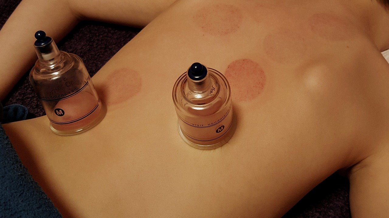 cupping, health, detoxify-3310182.jpg